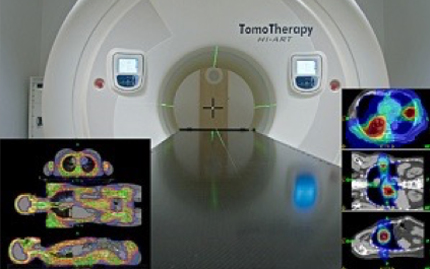 Виды рака, которые можно вылечить при помощи томотерапии PHOTO01